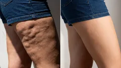 5 Gewohnheiten, um Cellulite an Oberschenkeln und Gesäß für immer loszuwerden